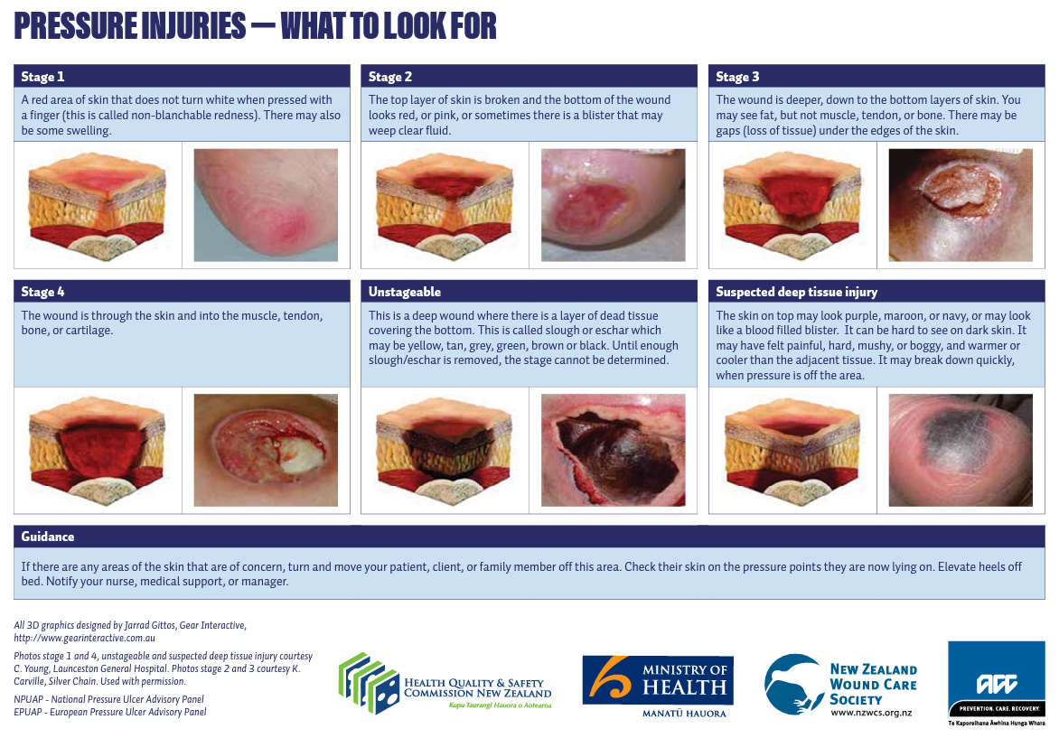 Pressure injury staging chart